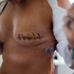 Breast Implants vs. Mammograms: Debunking Myths